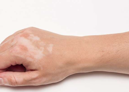 علت بروز «پیسی» را اینجا بخوانید…