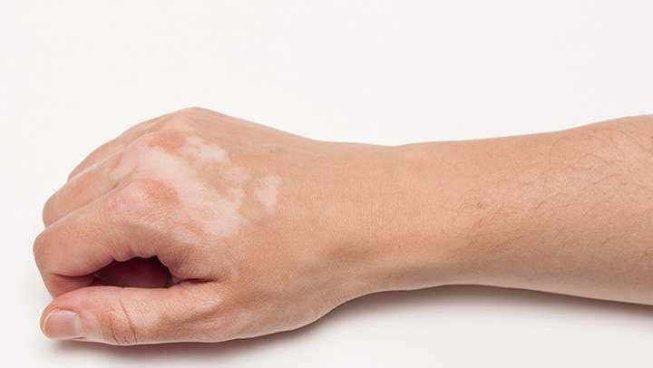 علت بروز «پیسی» را اینجا بخوانید…